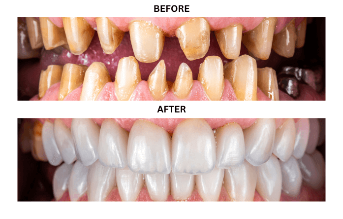 veneers-1316985053.png