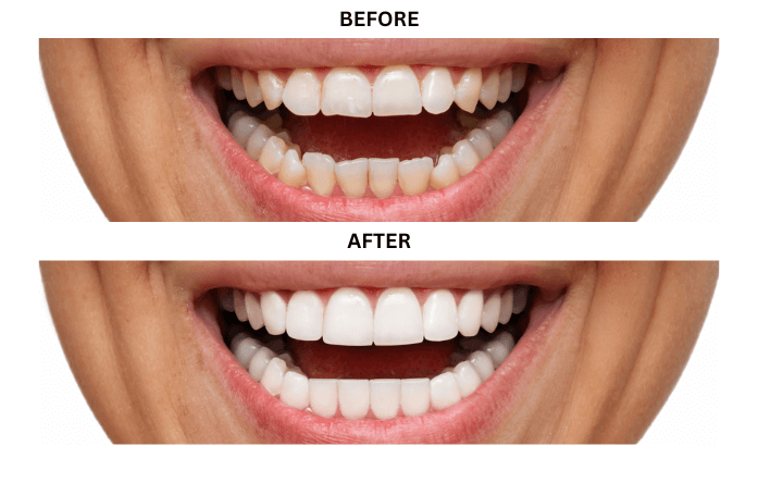 veneers-14338606192.png